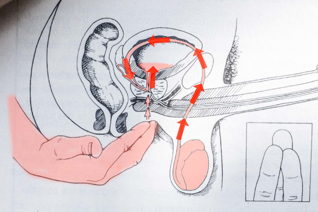 Diagram of a retrograde ejaculation happening